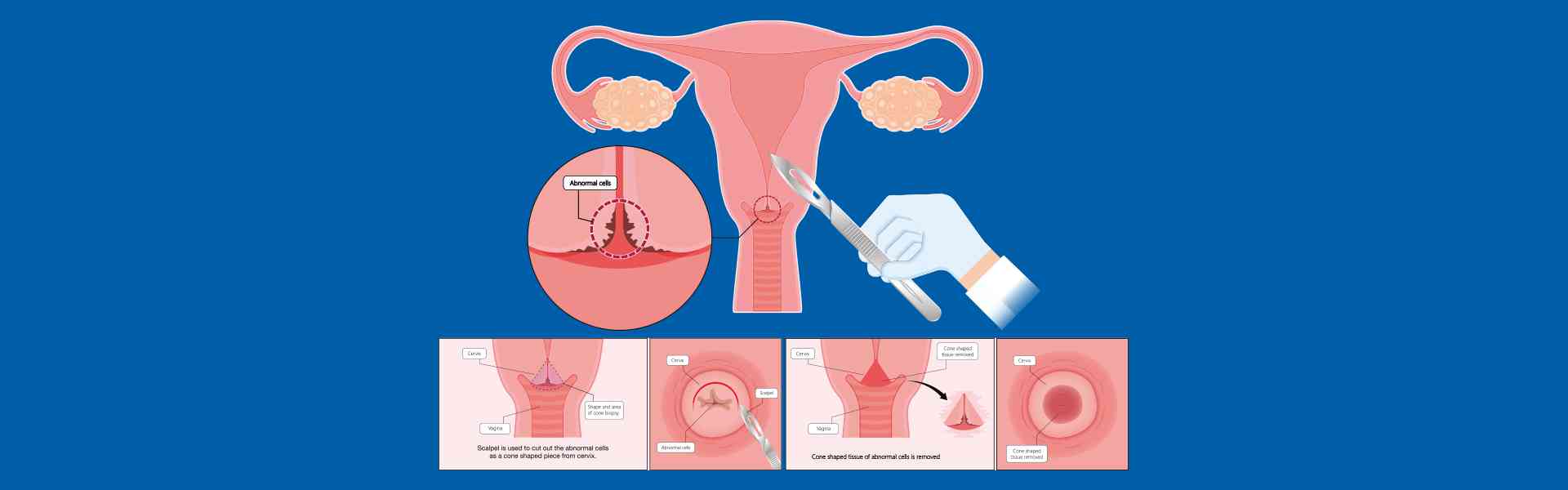 Pap Smear Treatment in Mysore 