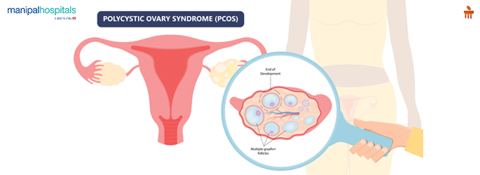 Myths and facts about Polycystic ovary Syndrome