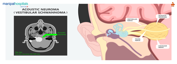 Vestibular Schwannoma Treatment in Old Airport Road, Bangalore