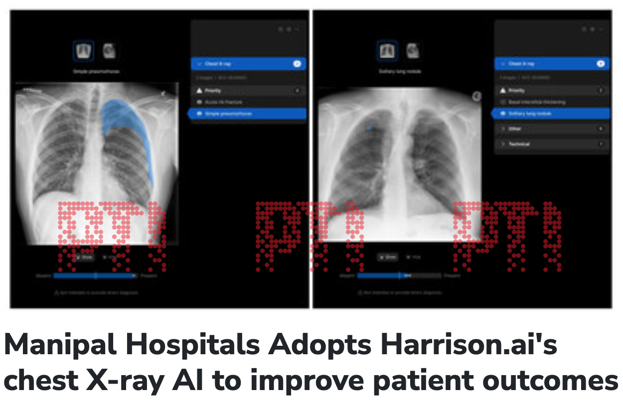 Manipal Hospitals Adopts Harrison.ai's chest X-ray AI to improve patient outcomes