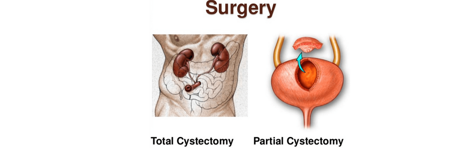 Partial and radical cystectomy in Old Airport Road