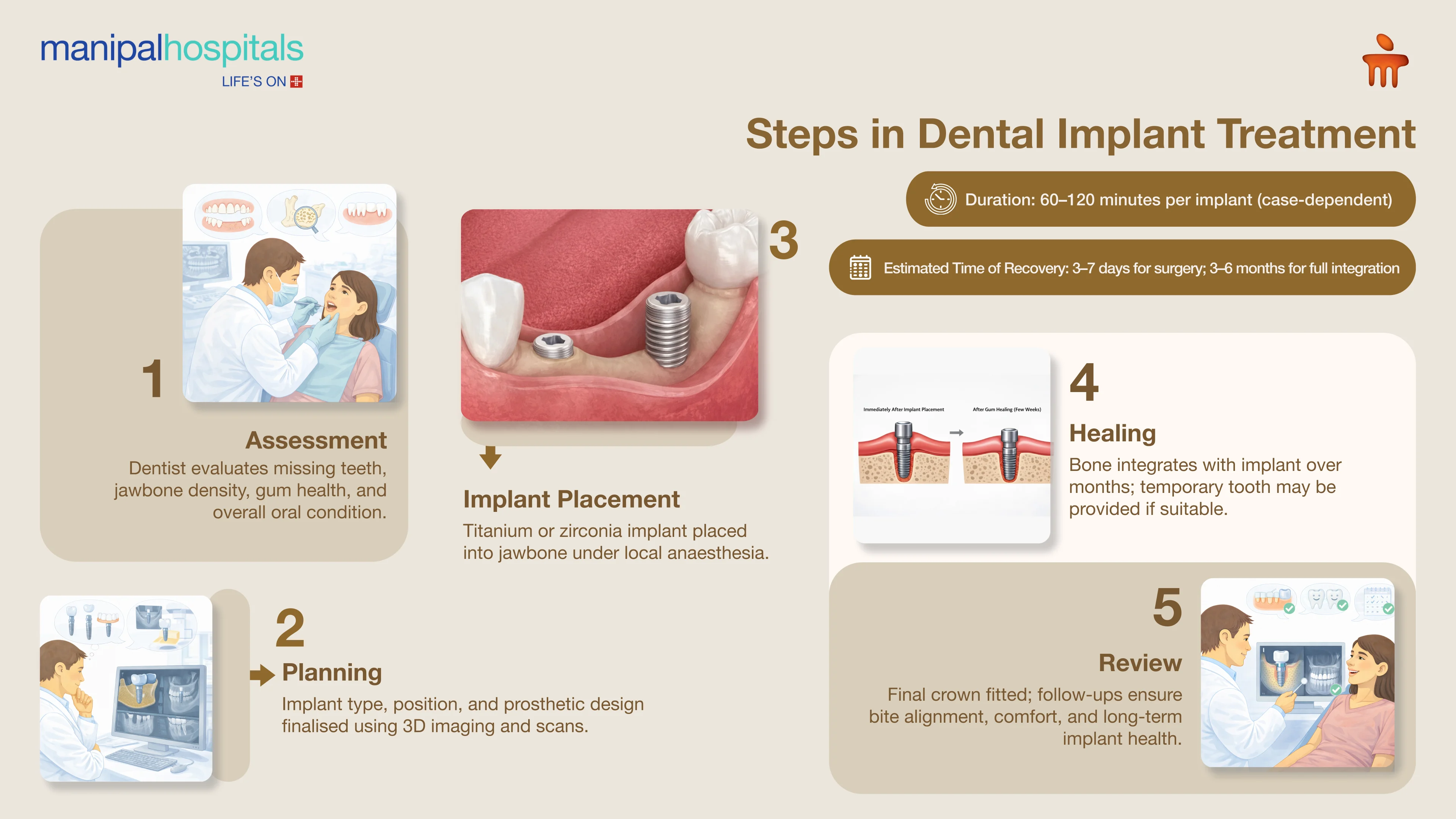 Dental Implants in Ranchi | Manipal Hospitals