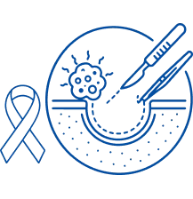 Cancer Resection Defect Surgery in Salem | Manipal Hospitals