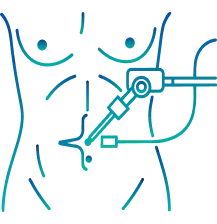 Minimally Invasive Surgery in Salem | Manipal Hospitals