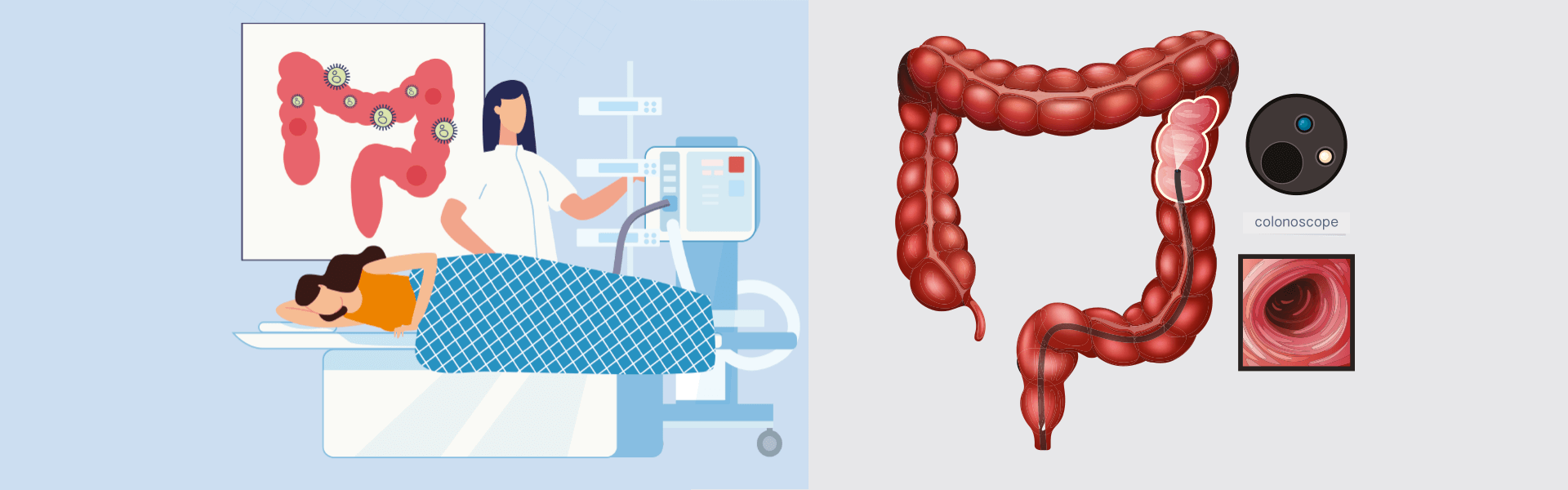 Colonoscopy in Salem | Gastro Hospital in Salem - Manipal Hospitals