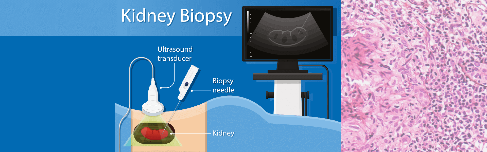 Kidney Biopsy in Salem | Kidney hospital in Salem - Manipal Hospitals