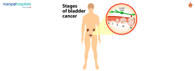 Bladder Cancer Treatment