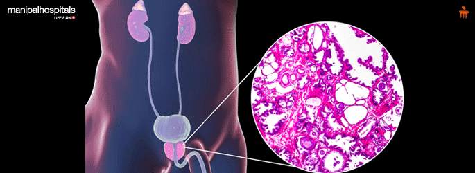 Urologist in Sarjapur Road