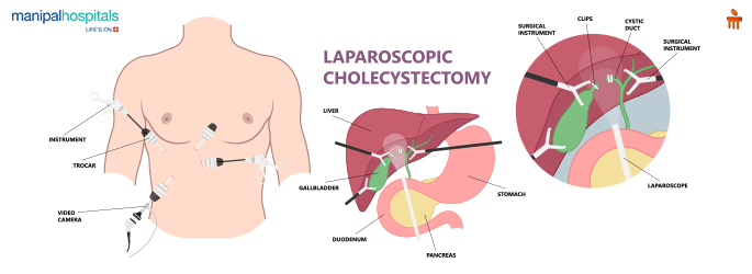 5 Alarming Symptoms of Gallstones