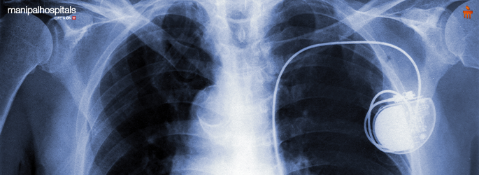 Advantage of traditional pacemaker implantation