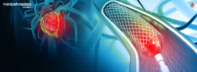 Angioplasty Procedure Explained: What to Expect, Recovery, and Risks