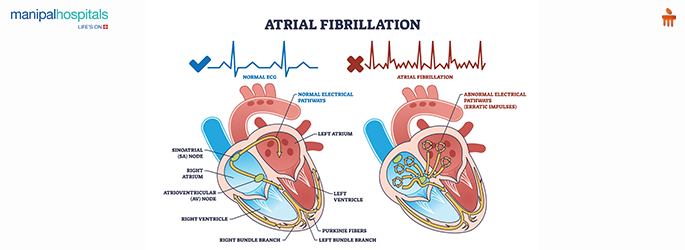Atrial Fibrillation Treatment