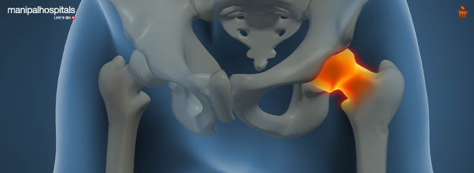 avascular necrosis symptoms   