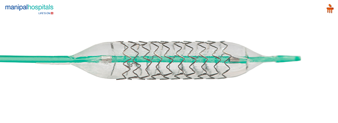 What is Balloon Angioplasty? Procedure, Uses, and Recovery