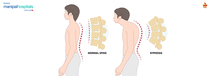 Balloon Kyphoplasty Procedure: Effective Spine Fracture Treatment for Back Pain Relief