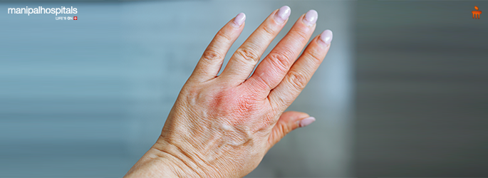 Bee Sting: Symptoms, Risks, and When You Should Seek Medical Help