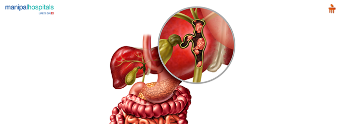 Bile Duct Cancer