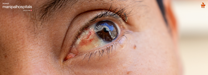 Causes and Treatment of Blood Clot in the Eye