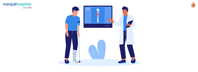 Bone Fractures: Types, Healing Time, and Care