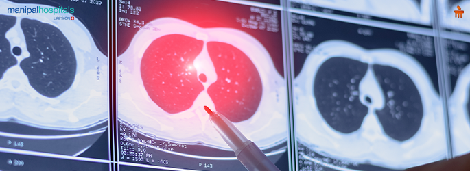 CT scan cancer detection