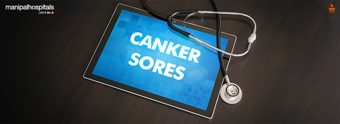 Illustration of canker sores inside the mouth with labels for minor, major, and herpetiform types.