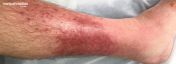 Cellulitis Treatment: Symptoms, Causes & Care