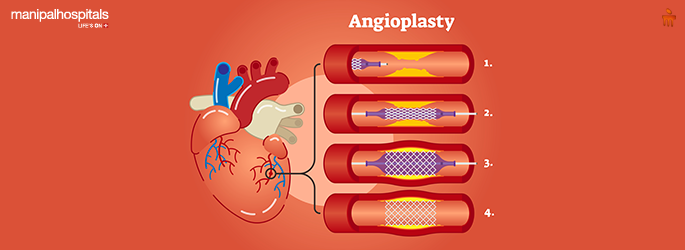 angioplasty