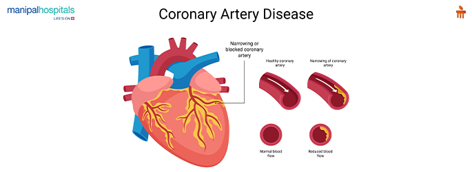 coronary artery disease