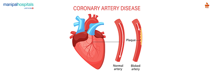 Coronary artery disease causes warning signs and treatment