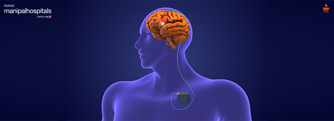 DBS Parkinson's Disease