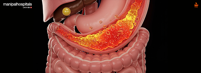Understanding Acid Reflux: Causes, Symptoms and Advanced Treatment