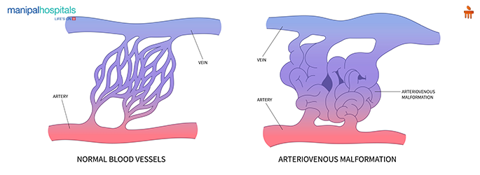 What is AVM