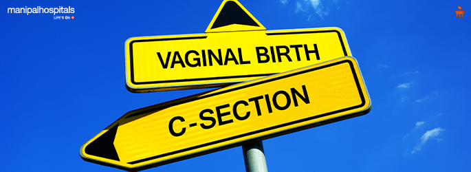 Demystifying C-Section Delivery: Why Doctors Recommend This Life-Saving Procedure