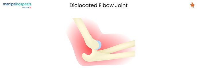 Dislocated elbow injury