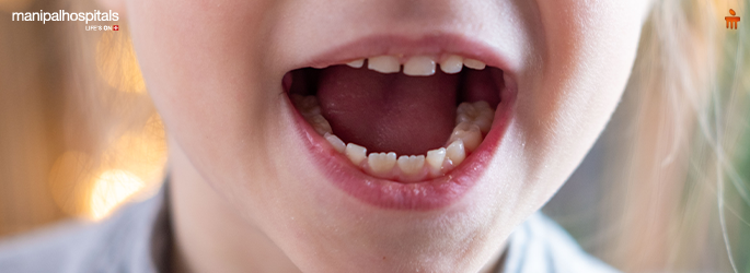 Early Childhood Caries: What Parents Must Know