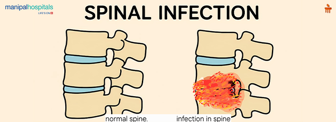 Warning Signs of a Spinal Infection