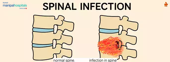 Warning Signs of a Spinal Infection