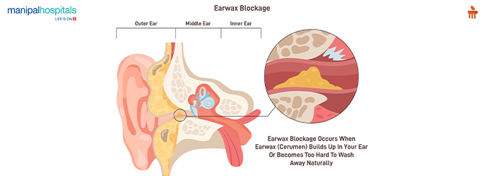 Earwax Blockage and How to Fix It Fast