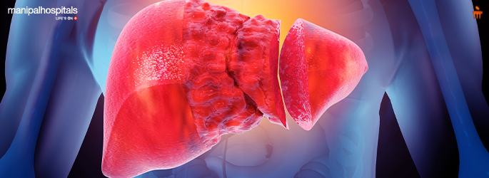 Fatty Liver Disease: Causes, Risk Factors, and Treatment Options