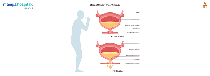 Frequent urination causes 