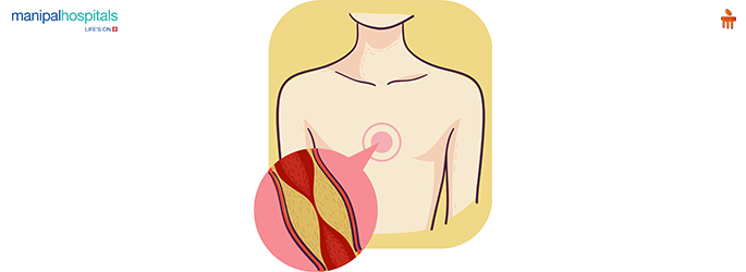 Heart Block: Causes, Symptoms, and Treatment Options