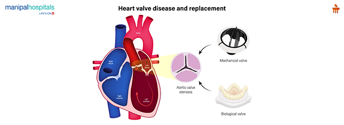 Aortic Valve Replacement