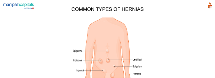Hernia Surgery: Types, Recovery & When You Need It