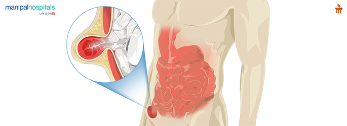 Hernia Treatment: When Is Surgery Required