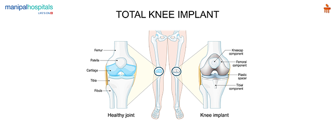 High Tibial Osteotomy
