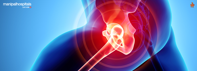 Hip Replacement Surgery