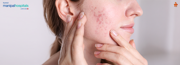 hormonal pimples