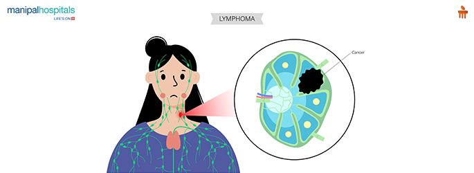 How Serious Is Lymphoma Cancer?