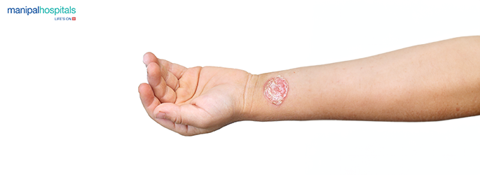 How to Identify and Treat Worm Infections Naturally and Medically