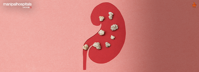 Kidney Stone Prevention Tips for a Healthy Urinary Tract